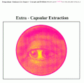 Earth  - Extra-Capsular Extraction